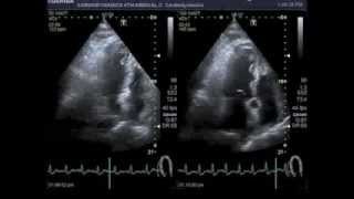 Bicycle stress echocardiography [upl. by Inohs]