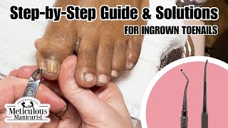 Tips For Instant Big Toe Pain Relief at Home nails satisfying [upl. by Atinnod]