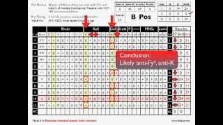 Antibody ID Basic Cases Part 2 [upl. by Asoj697]