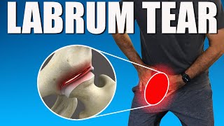 HIP LABRUM TEAR BEST Exercises Stretches amp Advice for Hip amp Groin Pain Relief [upl. by Madda711]