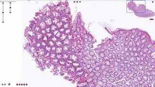 Hyperplastic Polyp  Colon  Histopathology [upl. by Deni]