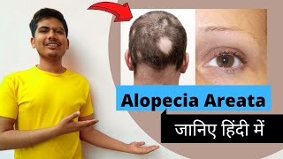 Things you should know about Alopecia Areata  Hair Loss Problems  Explained in Hindi [upl. by Enoed]