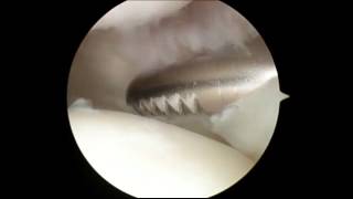 Knee  Plica Removal [upl. by Jelena]