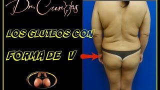 Levantamiento de gluteos forma de V  Aumento de Gluteos Dr Cortes [upl. by Newmark]