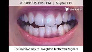 Aligners Journey  Invisible Braces Before And After [upl. by Liagibba746]