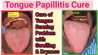 Tongue infectionGlossitis how to cure Fungal infection inside mouthTongue burning sensation cure [upl. by Slin]