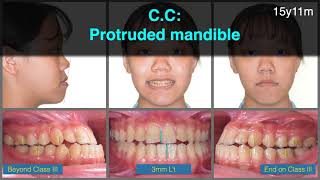 Treatment of Class III Malocclusion with Invisalign｜【Chris Chang Ortho】CC696 [upl. by Edmee]