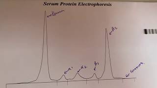 IgG lambda monoclonalitymultiple myelomaprotein electrophoresis and immunotyping for myeloma [upl. by Opportina]