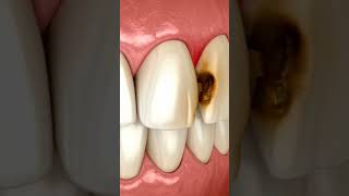 Dental caries class 3 composite restorationdentition restoration orthodontist dental [upl. by Nilatak]