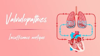 Insuffisance Aortique  Physiopathologie [upl. by Saylor579]