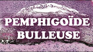 LA PEMPHIGOÏDE BULLEUSE  PATHOLOGIE [upl. by Alemaj521]