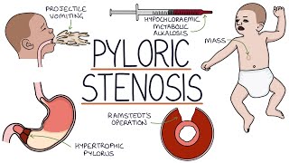 Understanding Pyloric Stenosis [upl. by Adnomar440]