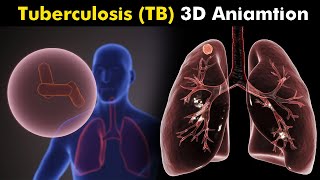 What Happens in Tuberculosis TB  3D Animation  Types Causes Symptoms Treatment UrduHindi [upl. by Aikemat420]