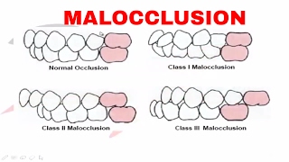 Malocclusion  Part I [upl. by Terena]