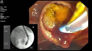 ERCP  Impacted ampullary stonepapillitis [upl. by Helbon]