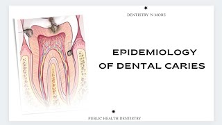 EPIDEMIOLOGY OF DENTAL CARIES [upl. by Jolenta]