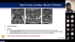 Neurogenic Claudication  Lateral Recess Stenosis  Ryan Khanna MD [upl. by Iahk683]