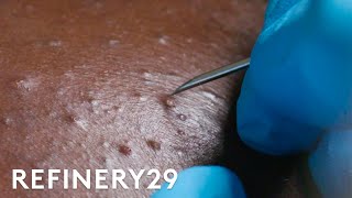 I Got Professional Blackhead Extractions  Macro Beauty  Refinery29 [upl. by Bergquist]