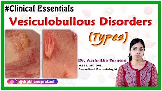 Vesiculobullous disorders Types Clinical essentials DrAashritha yerneni [upl. by Alisun987]