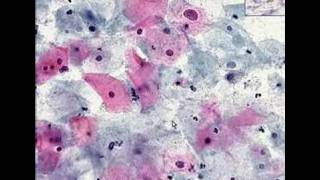 Histopathology CervixHigh grade squamous intraepithelial l [upl. by Raycher]