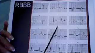 Differentiating Ectopy from Aberrancy [upl. by Assirralc61]