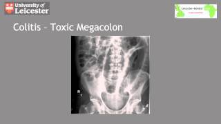 Abdominal XRays in 5 Minutes [upl. by Einahc522]