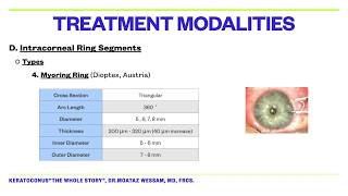 IntraCorneal Ring Segments ICRS Part 1 by DrMoataz Wessam [upl. by Yajnas]