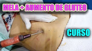 LIPOSUCCION MELA  AUMENTO DE GLUTEOS SIN CIRUGIA 😱 ANTES Y DESPUÉS CURSO 🔥 [upl. by Eibber]