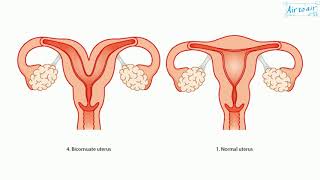 bicornuate uterus [upl. by Eceirtal]