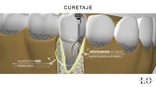 Periodoncia en Logroño raspado o curetaje [upl. by Galen]