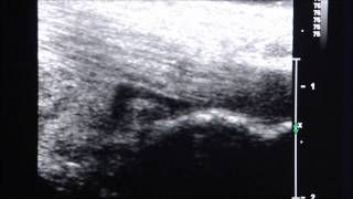 UltrasoundGuided Injection of Retrocalcaneal Bursitis [upl. by Adnalahs]