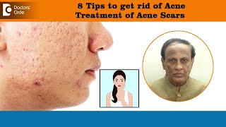 8 Tips to get rid of ACNE SCARS  Best Treatment for Deep Acne Pits  DrD A Satish Doctors Circle [upl. by Idihsar729]