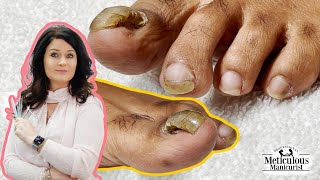 👣Tutorial on How to Care amp Treat a Detached Big Toenail with a Pedicure👣 [upl. by Tnayrb316]