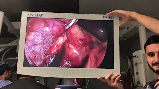 Laparoscopic Right Radical Nephrectomy for Rt Renal mass unedited speed 35 [upl. by Rechaba]