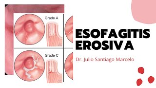 Esofagitis Erosiva [upl. by Attevaj]