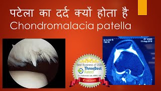 Chondromalacia Patella in Hindi [upl. by Htennek]