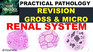 Practical Pathology Renal system Chronic pyelonephritis RCC amp Wilms tumor [upl. by Olim]