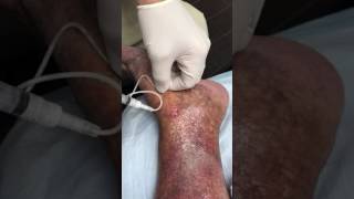 Rapid Healing of Venous Ulcers After Foam Sclerotherapy Treatment [upl. by Yltsew]