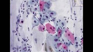 Histopathology Cervix Low grade squamous intraepithelial l [upl. by Harewood]