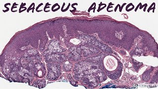 Sebaceous Adenoma 5Minute Pathology Pearls [upl. by Carter]