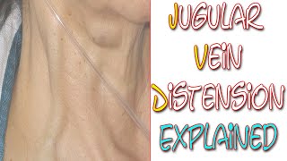 What Is Jugular Vein Distention  Something In About 5 Minutes  Medic Materials [upl. by Zweig]