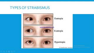 STRABISMUS [upl. by Ettedo]