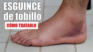 Esguince de tobillo mal curado o crónico  Fisioterapia Bilbao [upl. by Dan]