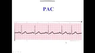 Premature Atrial Complex  Bigeminy  Trigeminy [upl. by Ddot738]