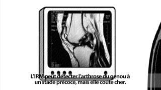 Larthrose est une maladie qui se soigne [upl. by Akimert884]