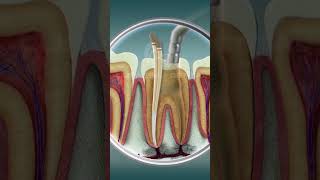 Root Canal Treatment  Curveia Dental I RCT [upl. by Essilrahc]