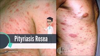 What is Pityriasis Rosea [upl. by Tallula]