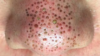 Acne treatment pimples popping blackhead removal on the nose 032 [upl. by Dalpe805]