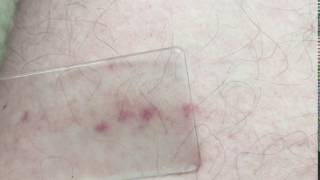 Glass test  Meningitis rash [upl. by Elleirol]