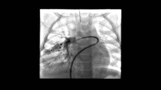 Pulmonary Arteriovenous MalformationsVascular Plug Embolisation [upl. by Ayrolg]